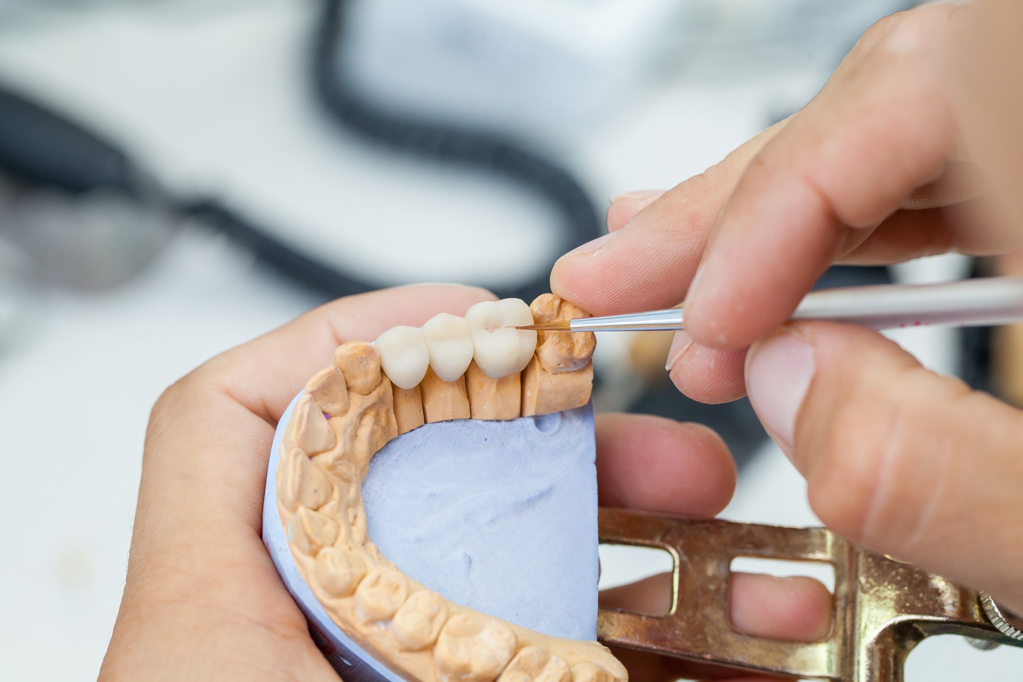 Dental Implants or a Bridge: What Should I Weigh?